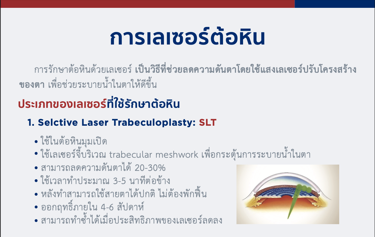 การเลเซอร์ต้อหิน