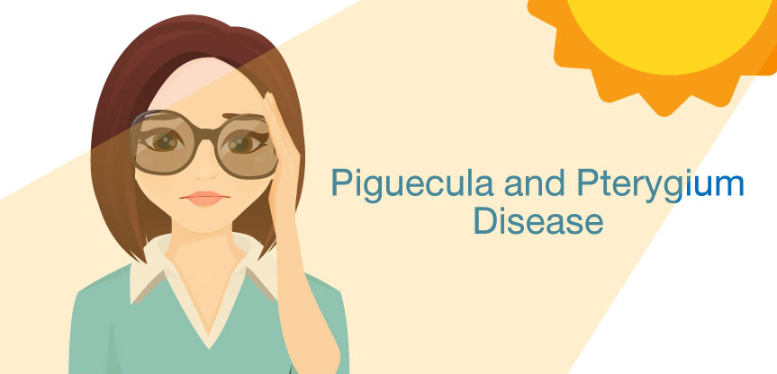 Piguecula and Pterygium